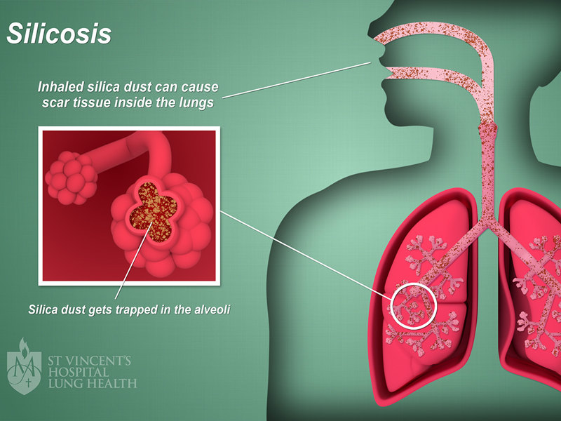Silicosis